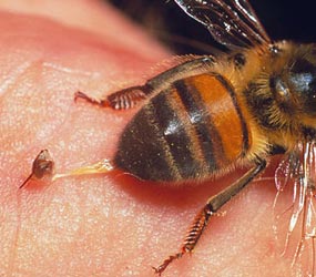 bee sting